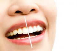 Achieve a Radiant Smile with Wellness Dental Studio – Best Teeth Whitening in Singapore