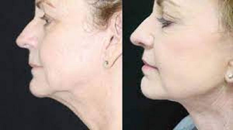 How Much Does a Neck Liposuction cost? |Liposuction cost