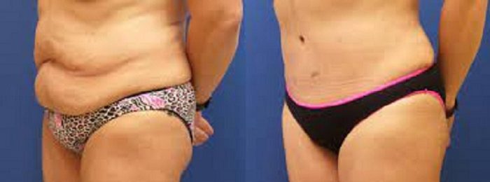 Liposuction Services In Houston |Liposuction