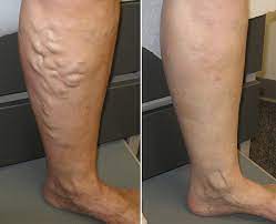 What is the Treatment for Varicose Veins?