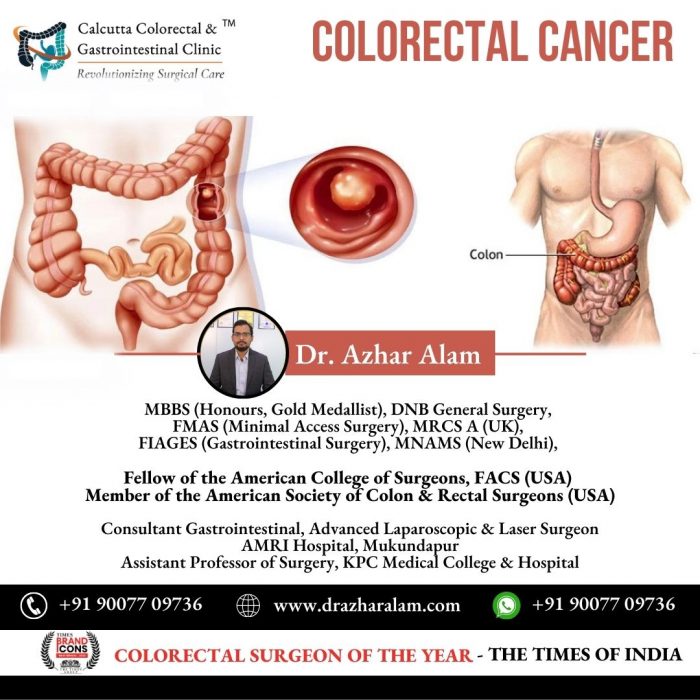 Colorectal Cancer Doctor in Kolkata