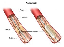 Get Angioplasty Test