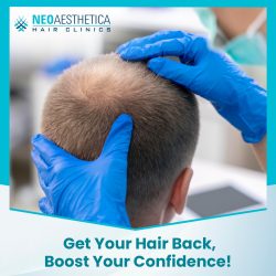 Best Hair Transplant Clinic Lucknow