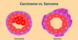CARCINOMA AND SARCOMA: THE DIFFERENCE