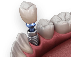 Discover the Benefits of Dental Implants at Hehr Oral Surgery in Summerville, SC