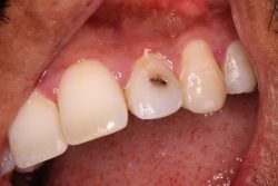 Fix Cavity on Front Tooth | chipped tooth
