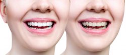 Fix Cavity on Front Tooth | Front Tooth