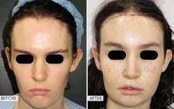 Facial Feminization Surgery Before and After
