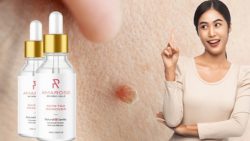 Amarose Skin Tag Remover Surveys – Deductively Demonstrated Recipe?