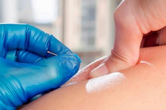 How does acupuncture dry needling provide relief?