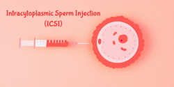 Intracytoplasmic Sperm Injection (ICSI)