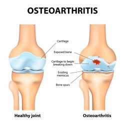 Ayurvedic Treatment for Osteoarthritis