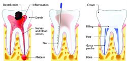 Root Canal Benefits Over Tooth Removal