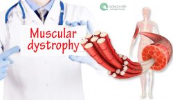 Muscular Dystrophy Types, Symptoms, Diagnosis And Treatment