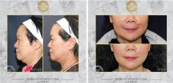 Anti Ageing clinic in Richmond | Ultherapy in Richmond