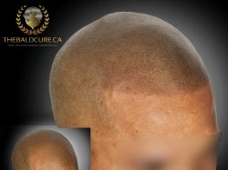 Get Natural-looking Scalp Micropigmentation Services in Vancouver, Canada