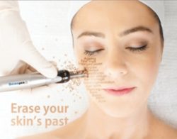 Get the Discoloration with Dermapen Microneedling Treatment in Ottawa!