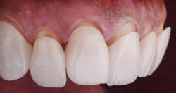 Procedure and Factors clarifying How Much Are Veneers