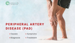 Peripheral Arterial Disease Symptoms