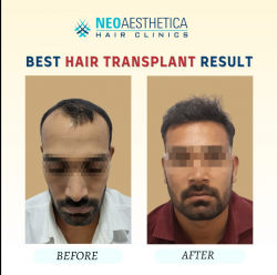 Best Hair Transplant Clinic – Neoaesthetica