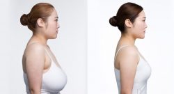 Comfort and Confidence: Breast Reduction Surgery in Delhi