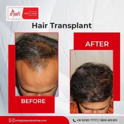 Revitalize Your Hair with Expert Hair Transplantation in Kolkata