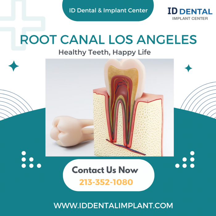Root Canal in Los Angeles | ID Dental and Implant Center