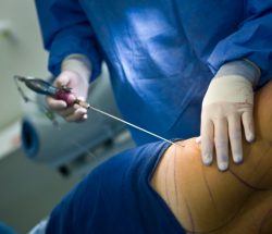 Trimming the Curves: Liposuction Surgery in Delhi