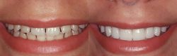 Broaden Your Smile with Exceptional Veneers for Teeth