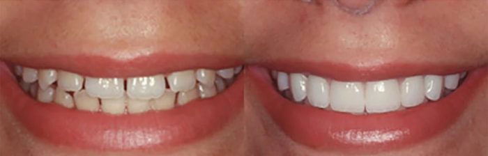 Broaden Your Smile with Exceptional Veneers for Teeth