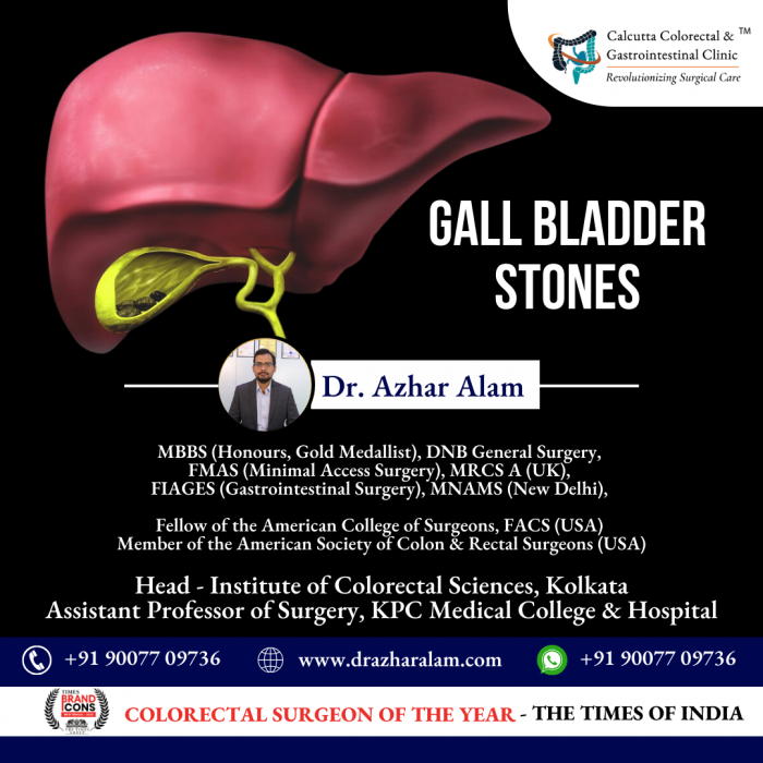 Advanced Laparoscopic Surgery for Gall bladder Stone in Kolkata