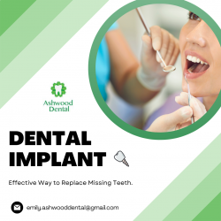 Best Dental Implant Solution for Your Tooth