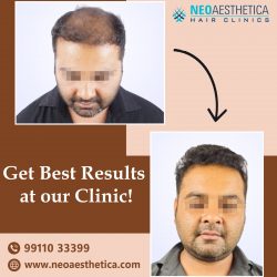 Best Hair Transplant Clinic- Neoaesthetica