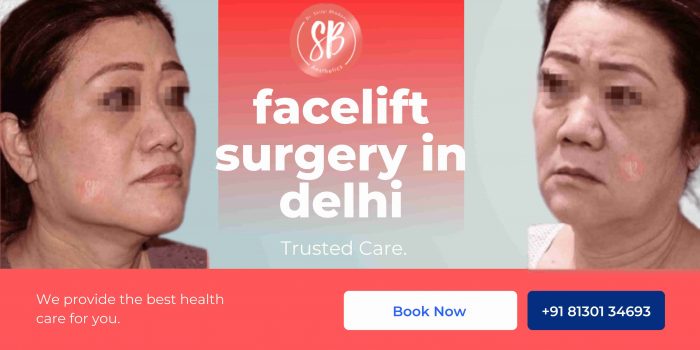 facelift surgery in Delhi