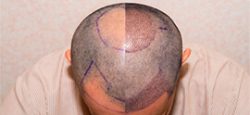 What does Redness after a Hair Transplant Indicate?