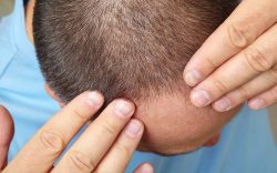 Hair Loss Treatment in India