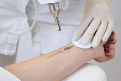 Most FAQ’s About Laser Tattoo Removal