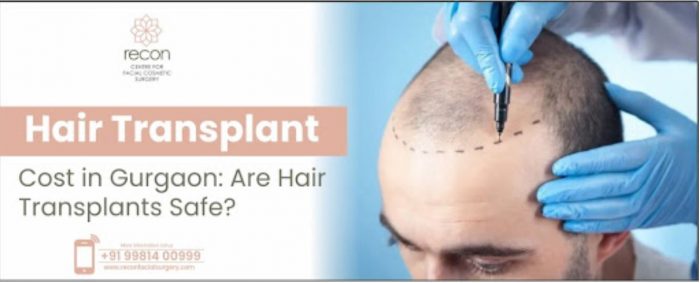Hair Transplant Cost in Gurgaon: Are Hair Transplants Safe