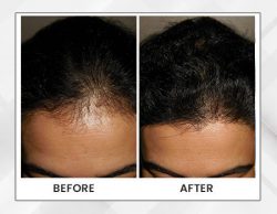 Book an Appointment at Dr Pauls for Hair Transplant in Kolkata