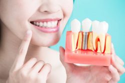 How to Care for Your Dental Implants?