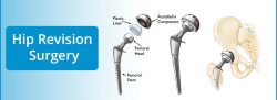 Complete Revision Hip Replacement Surgery