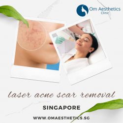Radiant Skin Awaits: Laser Acne Scar Removal in Singapore