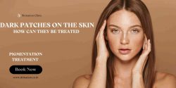 pigmentation treatment for Dark Patches On The Skin
