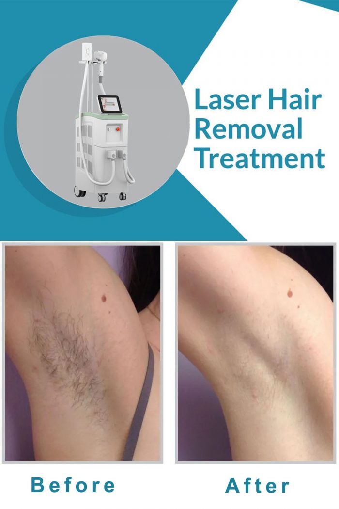 Professional diode laser hair removal machine. Laser hair removal is permanent.