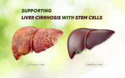 Stem Cells for Fatty Liver Disease