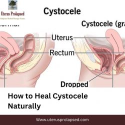 How To Heal Cystocele Naturally?