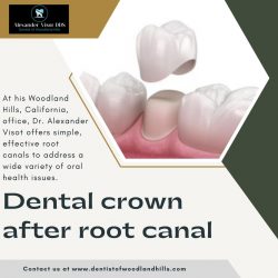 Dental Crown Placement After A Root Canal | Dentist of Woodland Hills