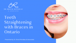 Teeth Straightening with Braces in Ontario – Dr. Brock Rondeau & Associates