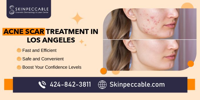 Treat Your Acne Scars