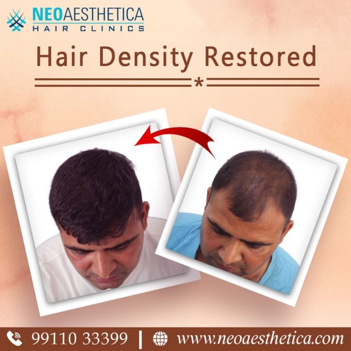 Choose For The Best Hair Transplant Clinic For The Best Hair Transplant Treatment